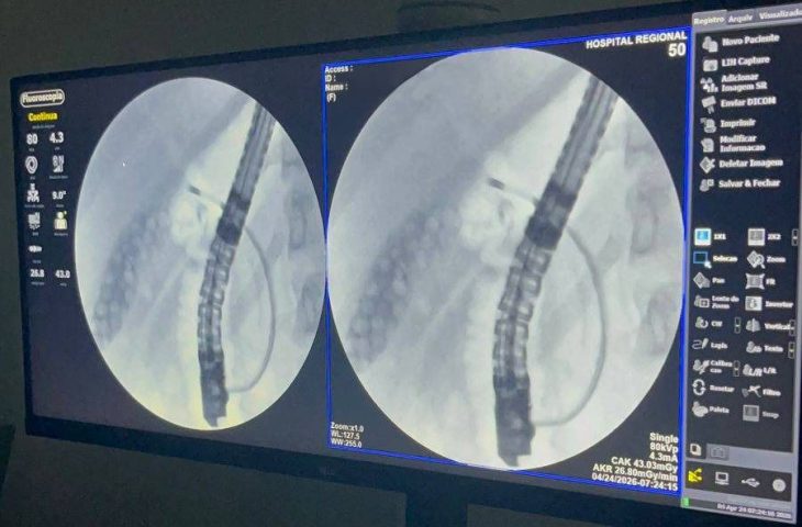 Exame inédito marca avanço da alta complexidade no Hospital Regional de Dourados Exame inédito marca avanço da alta complexidade no Hospital Regional de Dourados