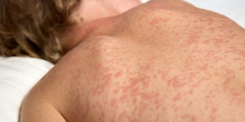 Foto: Reprodução Ministério da Saúde